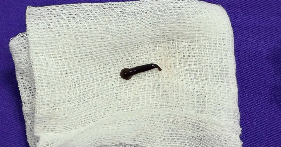 Live Leech Removed From Woman's Voice Box After Two Weeks of Throat Discomfort